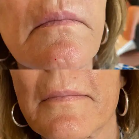 What to Expect During Filler Treatment image